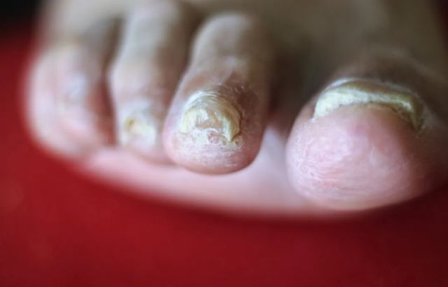 how long does it take bleach to kill toenail fungus